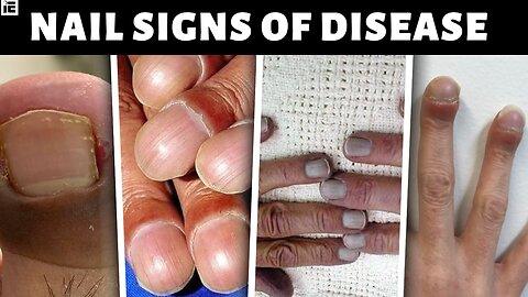 What your Nails Reveal about your Health