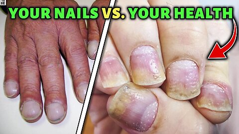 What your Nails Reveal about your Health