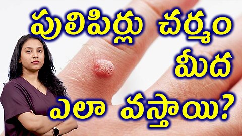 పులిపిర్లు, మొలలు చర్మం మీద ఎలా వస్తాయి? Structure of Skin Related to Warts Homeopahty Treatment