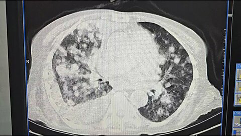 lung Cancer ♋