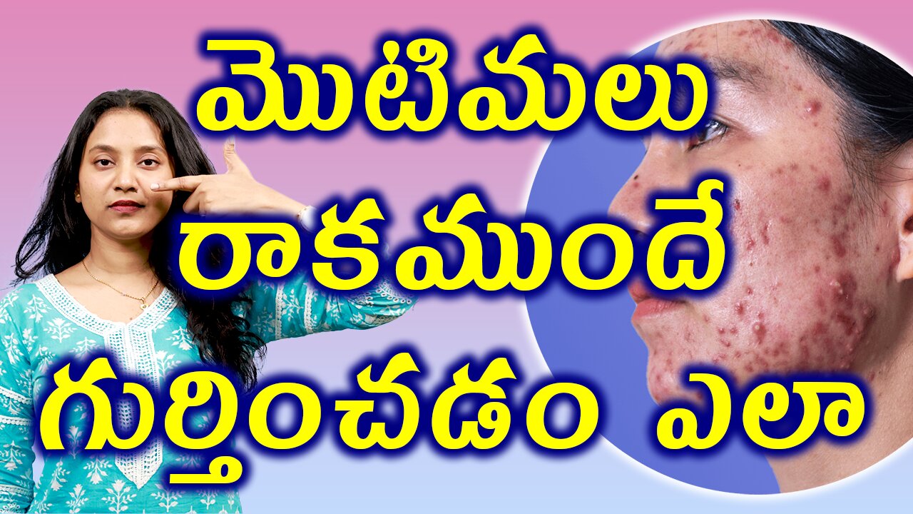 మొటిమలు రాకముందే గుర్తించడం ఎలా? What is ACNE or Pimples Signs Symptoms | డా. భరద్వాజ్ | హోమియోపతి