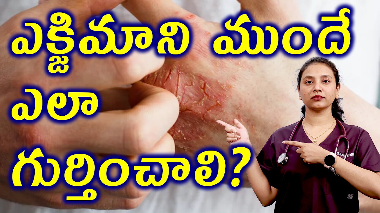 ఎక్జిమాని ముందే ఎలా గుర్తించాలి? Signs and Symptoms of Eczema Treatment Cure Solution | హోమియోపతి