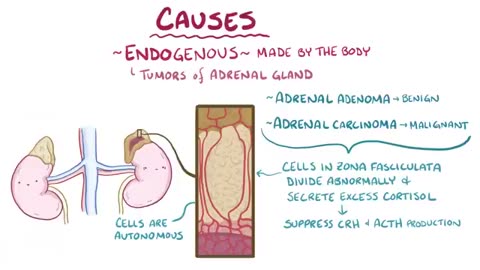 Cushing Syndrome - causes, symptoms, diagnosis, treatment, pathology