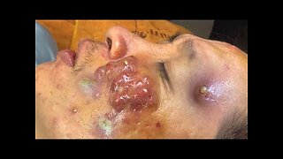 Satisfying blackhead removal and Pimplepopping Spa relaxation 335