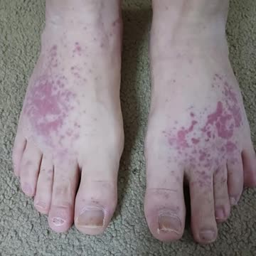 Showing photos of a Rash