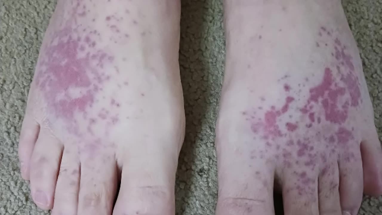 Showing photos of a Rash