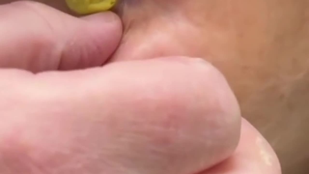 Katie Piper adopts new prosthetic eye after 'battling' eye issues