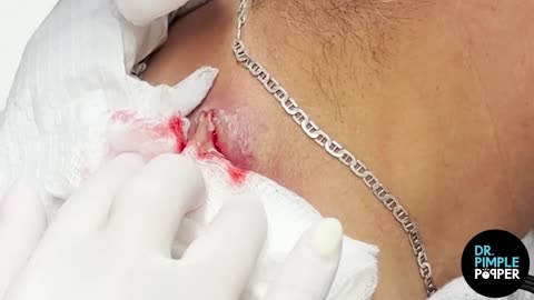 WHAT IS THAT Dr Lee Pops Satisfying Back Cyst Dr Pimple Popper Reacts