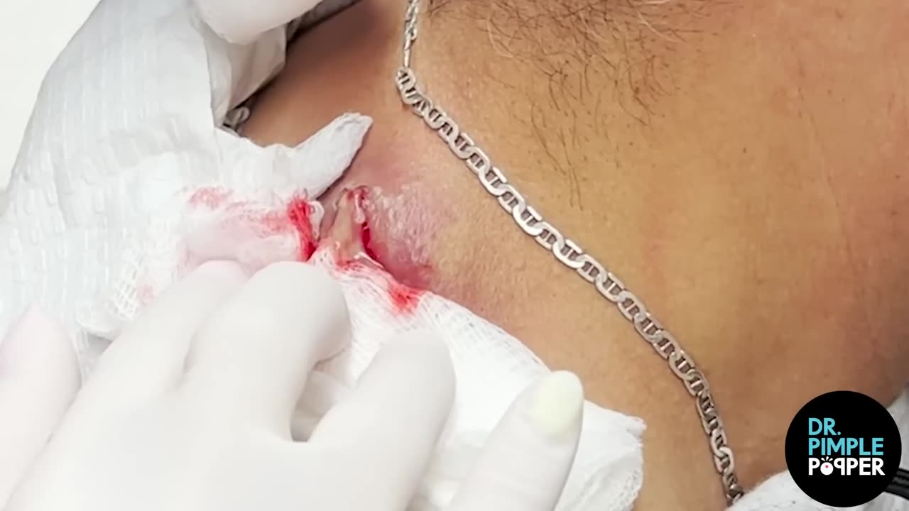 WHAT IS THAT Dr Lee Pops Satisfying Back Cyst Dr Pimple Popper Reacts