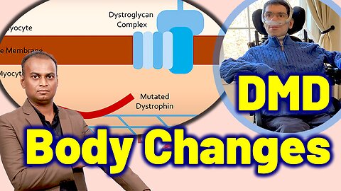 Changes in the body due to Duchenne Muscular Dystrophy DMD | Dr. Bharadwaz | Homeopathy, Medicine