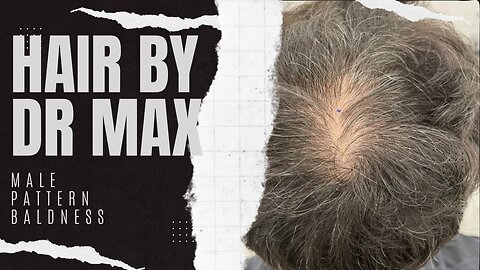 Male Pattern Baldness - Hair By Dr. Max