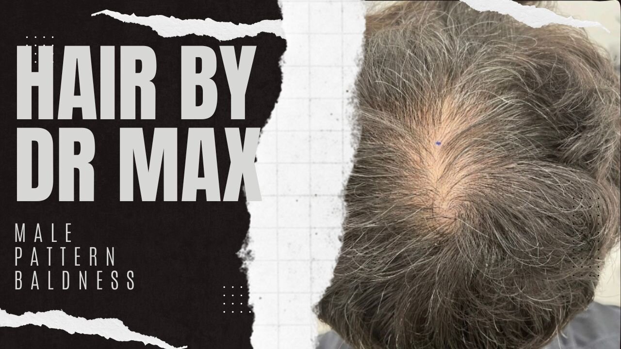 Male Pattern Baldness - Hair By Dr. Max