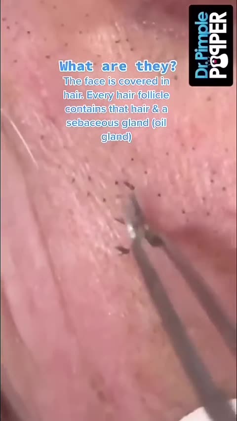 Sebaceous filaments and blackheads can look very similar but theyre not the same thing️
