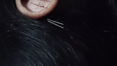 "Auricular Therapy: Unlocking the Power of Ear Acupuncture for Healing!"