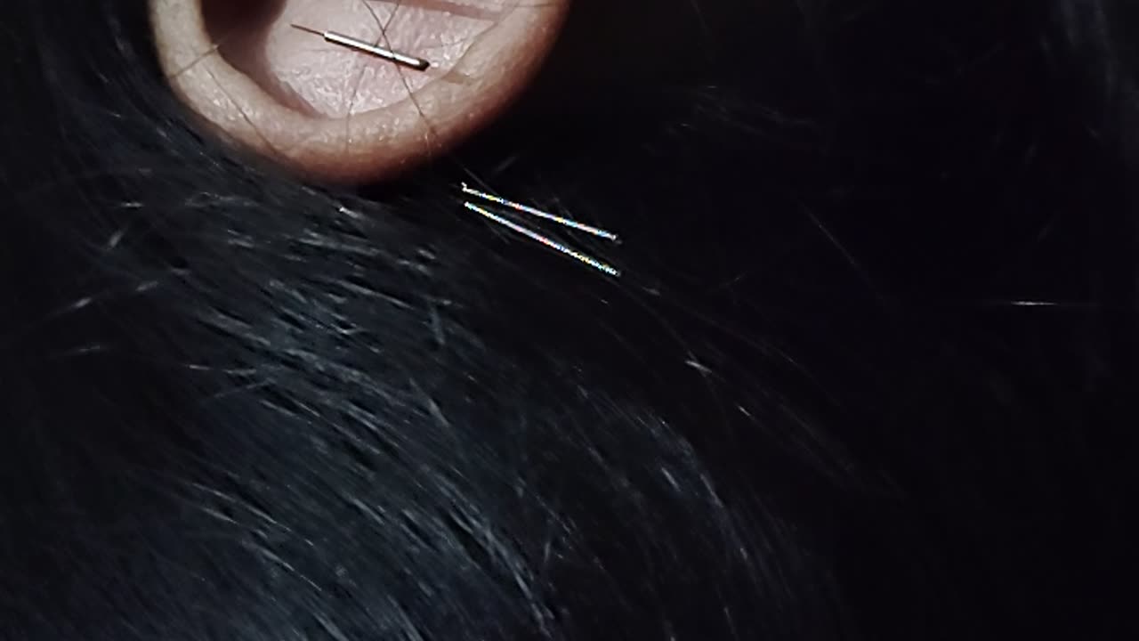 "Auricular Therapy: Unlocking the Power of Ear Acupuncture for Healing!"