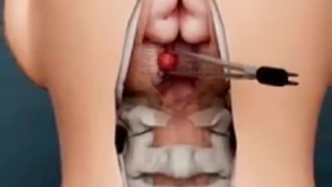 How Brain Clot Is Removed? (3D Animation) #shorts