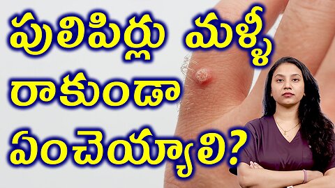 పులిపిర్లు మొలలు, పెండ్లలు మళ్ళీ రాకుండా ఏంచెయ్యాలి? Get Rid of Warts with Best Homeopathy Treatment