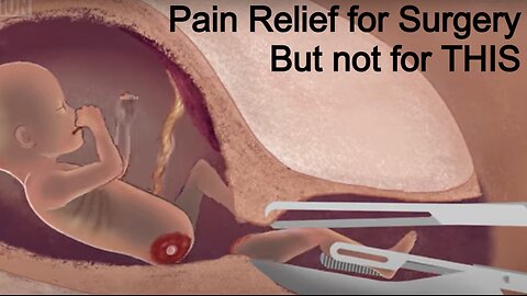 Pain Relief for Surgery -- But Not for Dismemberment