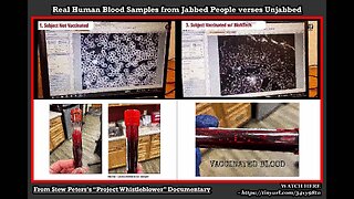 Real Human Blood Samples from Jabbed People verses Unjabbed