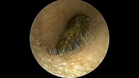 Unbelievable amount of ear wax