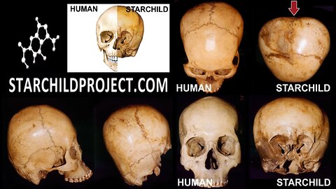 The Starchild Skull Is A Hybrid Born To A Homosapien Mother - Dr. Robinson