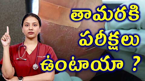 తామరకి పరీక్షలు ఉంటాయా? Tests and Investigations for Tinea, Ringworm Homeopathy Treatment హోమియోపతి