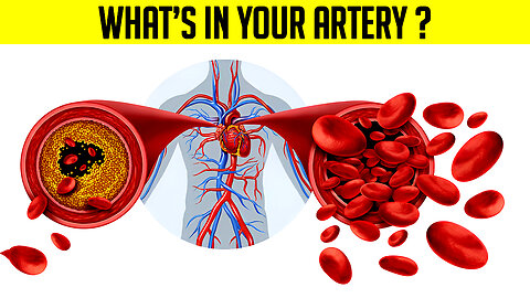 #1 Best AT HOME Test to Find Clogged Arteries