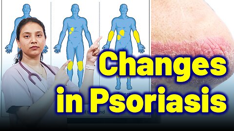 Body Changes in Psoriasis | Treatment and Cure | Homeopathy, Medicine & Surgery