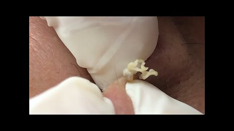 Awesome BIG POPS Blackheads Whiteheads Removal