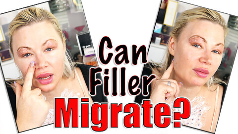 Can Filler Migrate? Let's Discuss! Wannabe beauty guru | Code Jessica10 saves you money