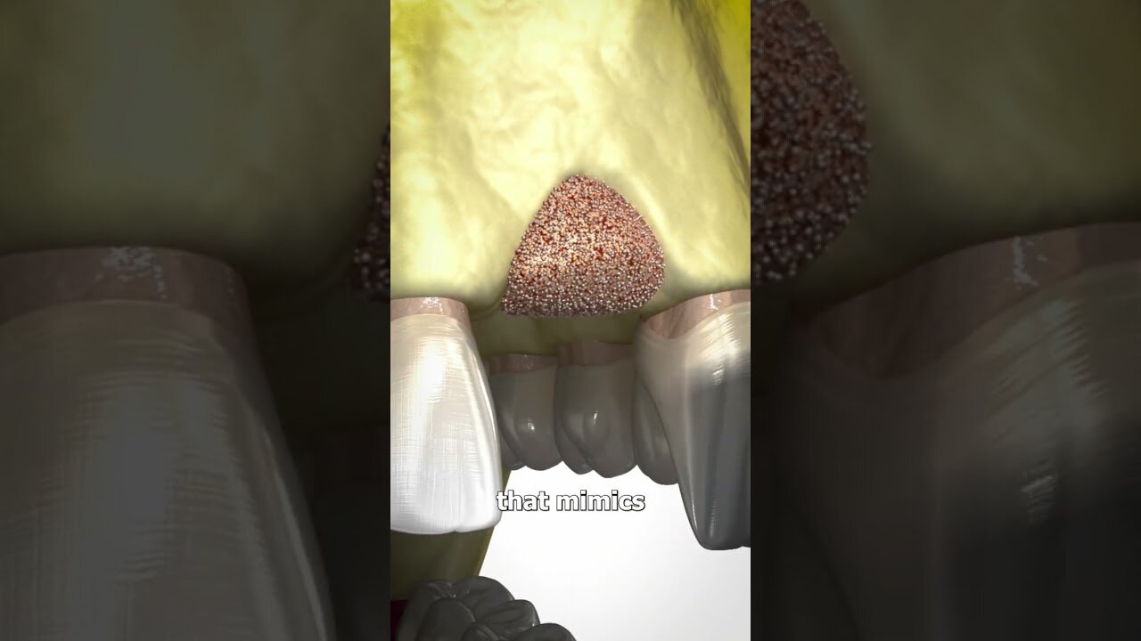 Bone Grafting Explained 🤔