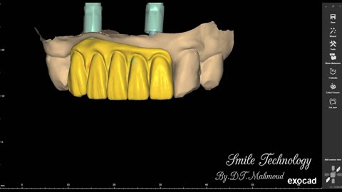 #design #naildesign #dental #dentaldesign #exocadexpert