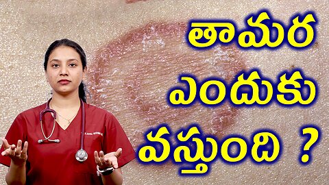 తామర ఎందుకు వస్తుంది? Causes and Riskfactors for Tinea or Ringworm Homeopathy Treatment | హోమియోపతి