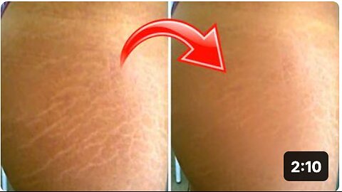 Mix These 3 Ingredients to Quickly Fade Your Stretch Marks
