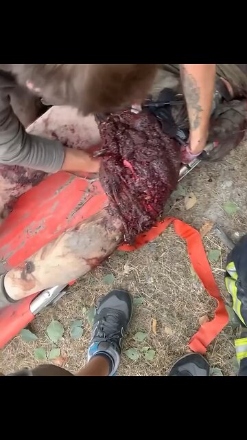 Ukrainian Leg Blown Off