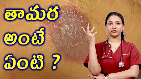 తామర అంటే ఏంటి? What is Tinea or Ringworm? Tinea Homeopathy Treatment Solution Cure | హోమియోపతి