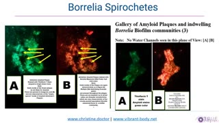 NEW RESEARCH REVEALS - ALZHEIMER CAUSED BY PARASITES