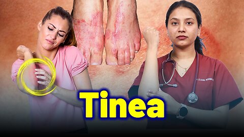 Tinea,Dermatophytosis, Ringworm . |Treatment & Cure| Homeopathy, Medicine & Surgery