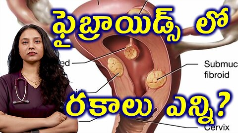 ఫైబ్రాయిడ్స్ లో రకాలు ఎన్ని? Types of Fibroids, leiomyomas or myomas | డా. భరద్వాజ్ | హోమియోపతి