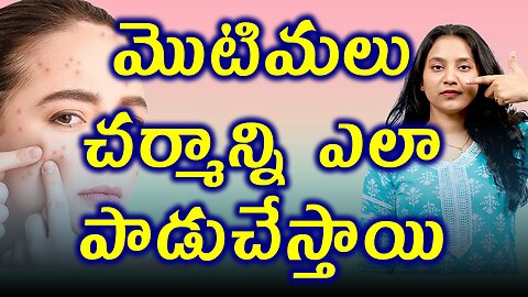 మొటిమలు చర్మాన్ని ఎలా పాడుచేస్తాయి Changes in the Body Due to ACNE Pimples or Blackheads | హోమియోపతి