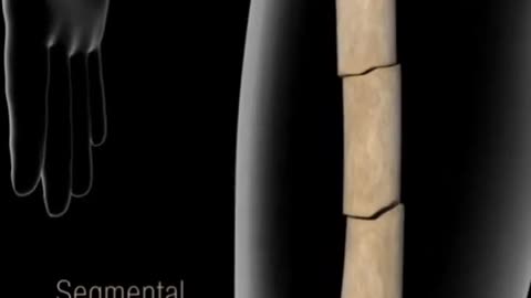 How many ways a bone can break?