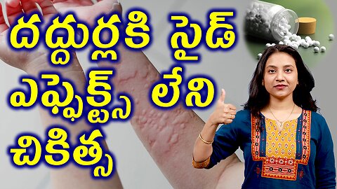 దద్దుర్లకి సైడ్ ఎఫ్ఫెక్ట్స్ లేని చికిత్స Advantages of Homeopathy in treating Urticaria hives wheals