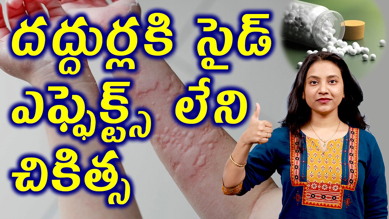 దద్దుర్లకి సైడ్ ఎఫ్ఫెక్ట్స్ లేని చికిత్స Advantages of Homeopathy in treating Urticaria hives wheals