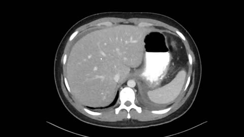 Gemini 2.0 AI Identifies Pancreatitis from a CT Scan—A Glimpse into the Future of Radiology?