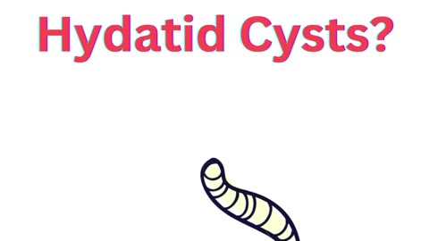 What Do You Know About Hydatid Cysts?