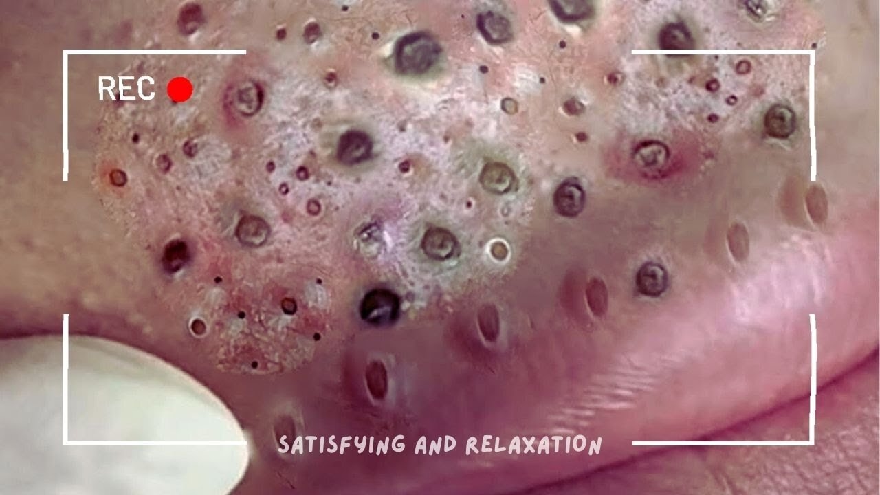 ASMR Removing ingrown hair from the skin Part 1 (Satisfying )
