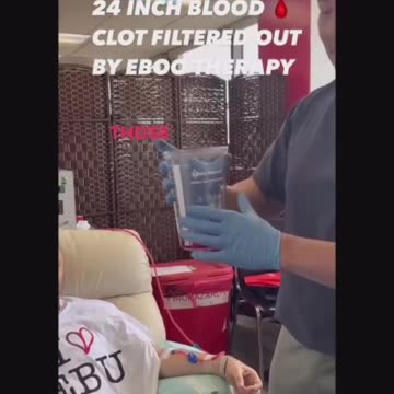 Pulling a 24 inch Blood Clot - Just Another Covid-19 Clot Shot Victim