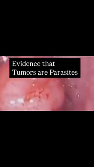 HEY, YOU WON’T BELIEVE WHAT’S HIDING OUT IN THIS TUMOR: IT TURNS OUT TUMORS CAN HOLD PARASITES! ☠️
