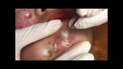 Blackheads and Pimple Popper