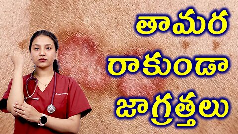 తామర రాకుండా జాగ్రత్తలు Precautions for Tinea or Ringworm Homeopathy Treatment Cure | హోమియోపతి